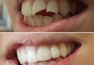 Broken Teeth Reconstruction, before and after