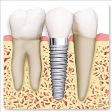 Global-Dental-Implants-Market