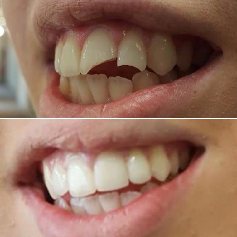 Broken Teeth Reconstruction, before and after