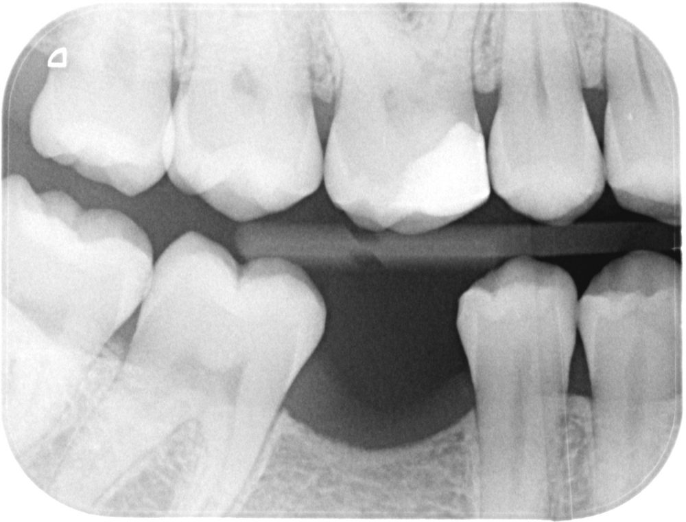 Bitewing X-ray