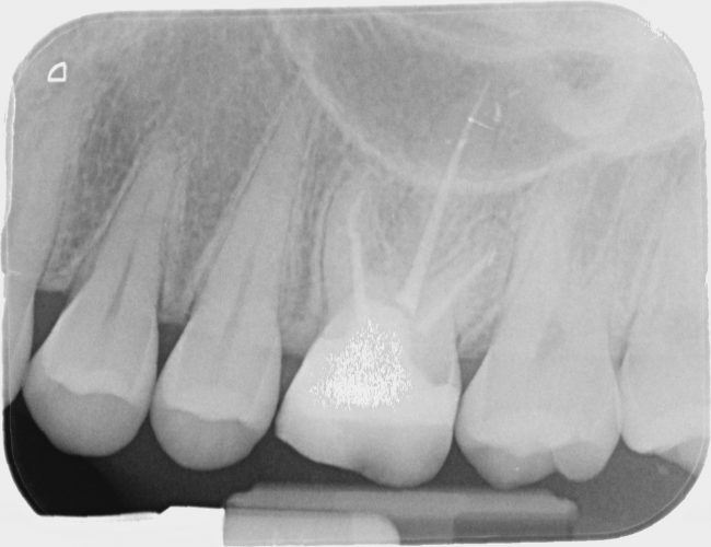 Periapical X-ray