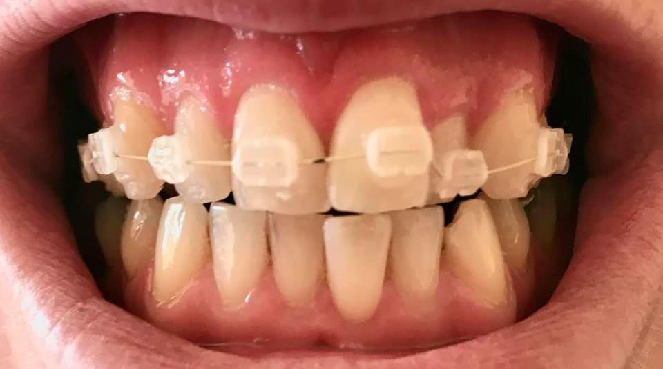 Invisalign Vs Fixed Braces - Brucegate Dental Practice