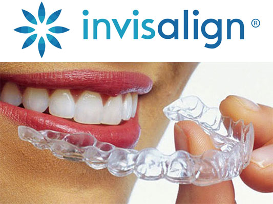 Invisalign clear aligners