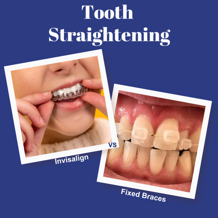 Tooth Straightening Invis V Fixed