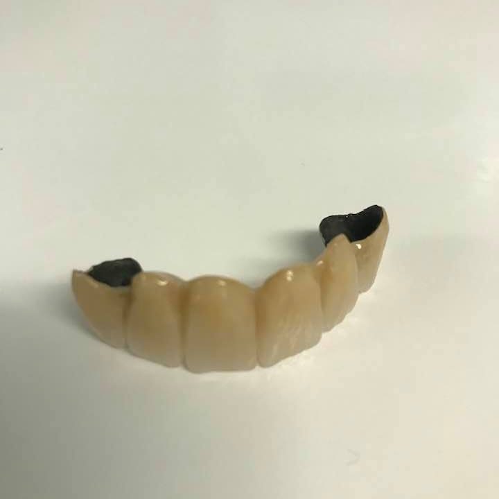 Bridge to replace four front teeth