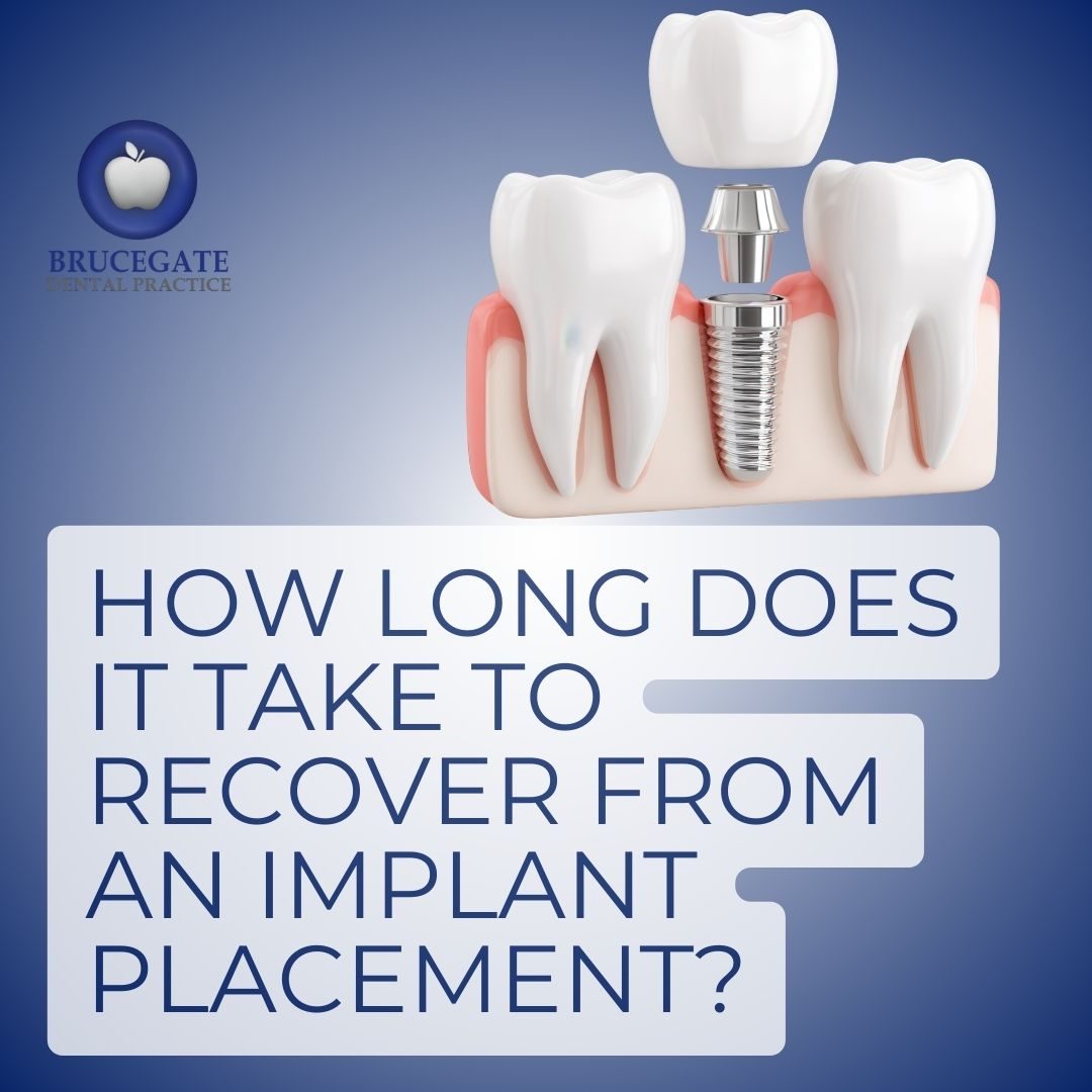 Dental Implant Placement