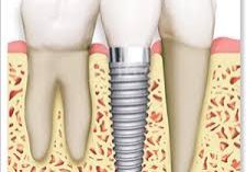 Global-Dental-Implants-Market