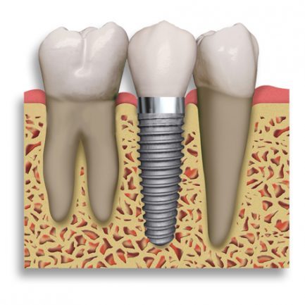 PageLines-dentalimplant2.jpg